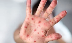 Zona (Gece Yanığı) Vakalarında Korkutan Artış! Belirtileri Neler?