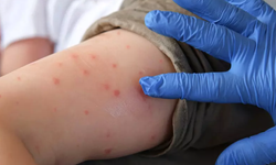 Su Çiçeği Vakaları Arttı: "İlk Defa Böylesini Görüyoruz"