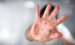 Zona Nedir, Neden Olur? Belirtileri Nelerdir ve Nasıl Tedavi Edilir? Gece Yanığı Hakkında Her Şey