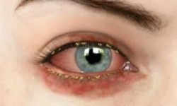 Göz yanması neden olur hangi hastalıkların belirtisi olabilir