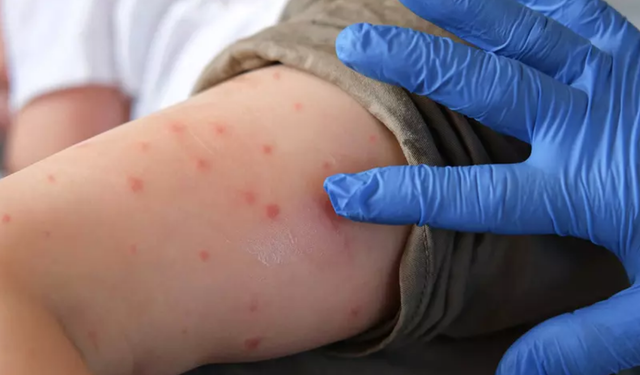 Su Çiçeği Vakaları Arttı: "İlk Defa Böylesini Görüyoruz"