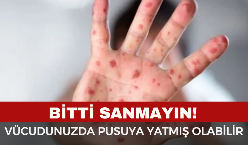 Zona (Gece Yanığı) Vakalarında Korkutan Artış! Belirtileri Neler?