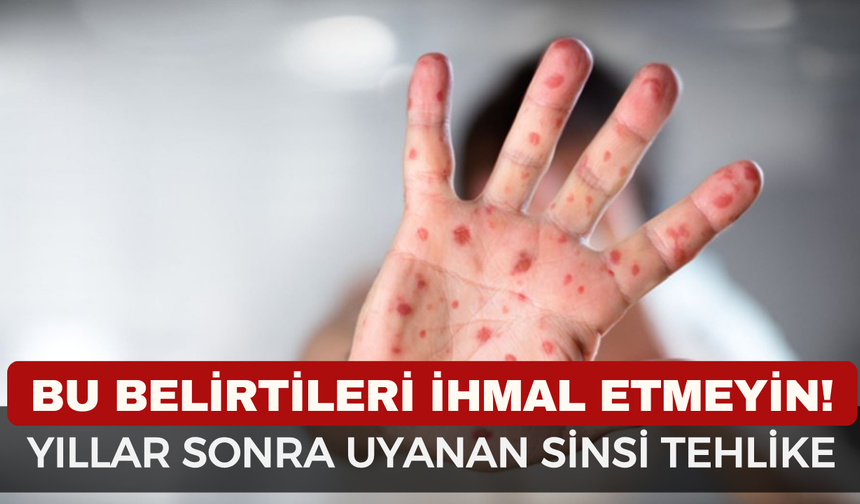 Zona Nedir, Neden Olur? Belirtileri Nelerdir ve Nasıl Tedavi Edilir? Gece Yanığı Hakkında Her Şey